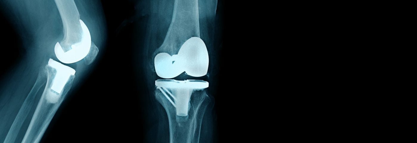 knee-arthroplasty-surgical-procedure-cubaheal