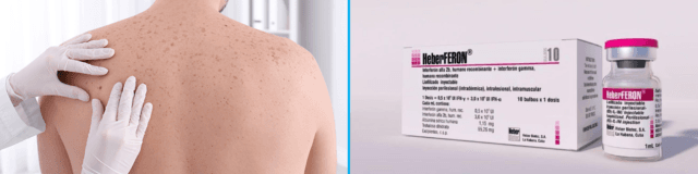 HeberFERON for the Treatment of Nevoid Basal Cell Carcinoma Syndrome
