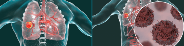  Non-Small Cell Lung Cancer