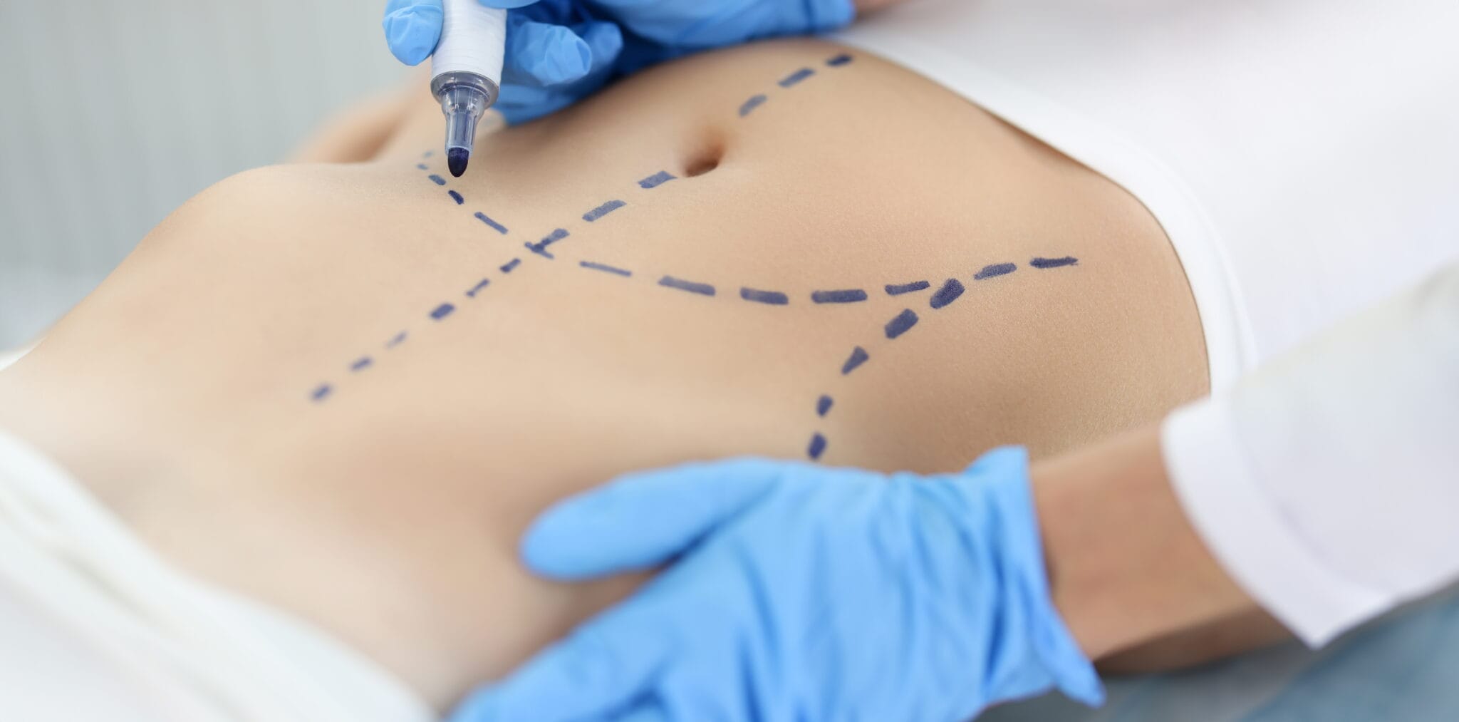 Lipoma Removal Surgery - CubaHeal