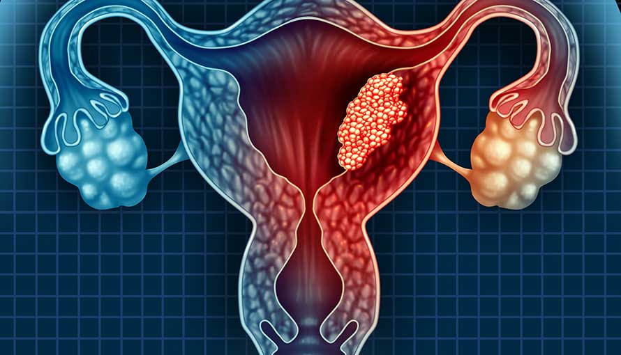 endometrial cancer