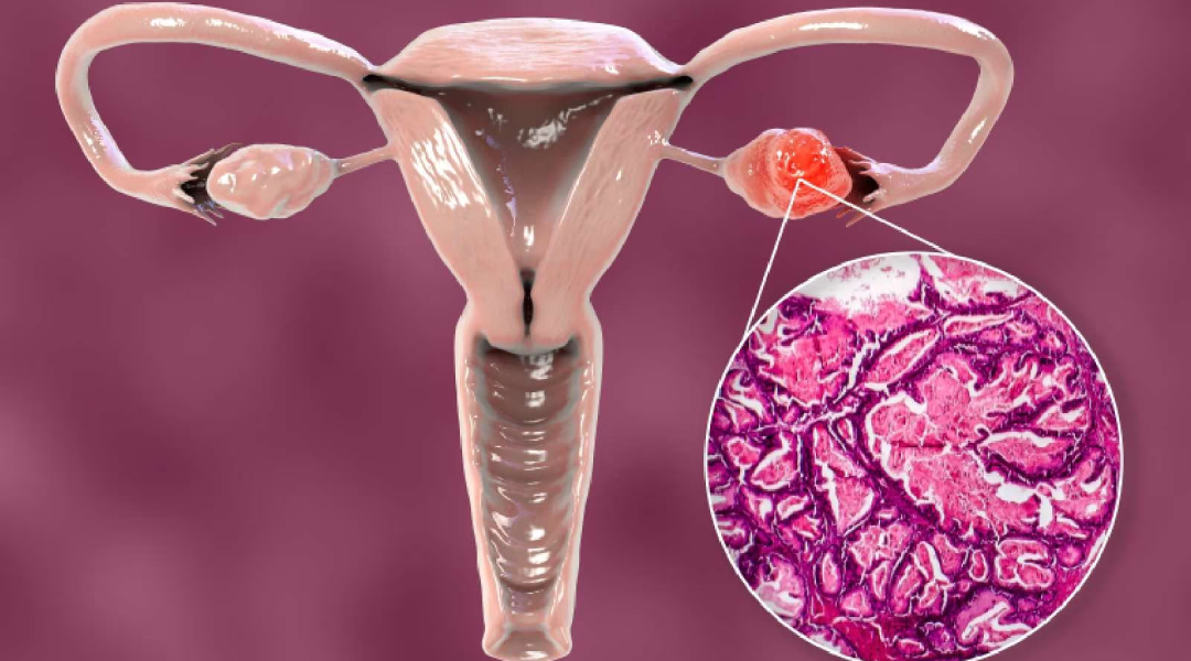 Ovarian cancer treatment